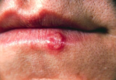 herpes pictures. got herpes in your mouth?