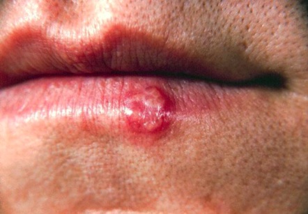 Mild Cold Sore