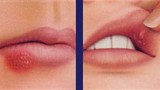 What is the difference between a cold sore and a canker sore? Is it true that if you have a canker sore, you have herpes?
