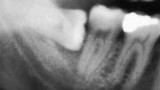 Why Do We Have Wisdom Teeth?