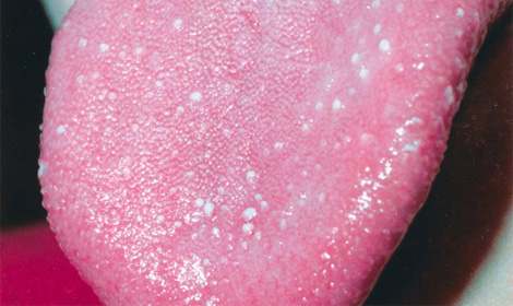 Herpes On Tongue