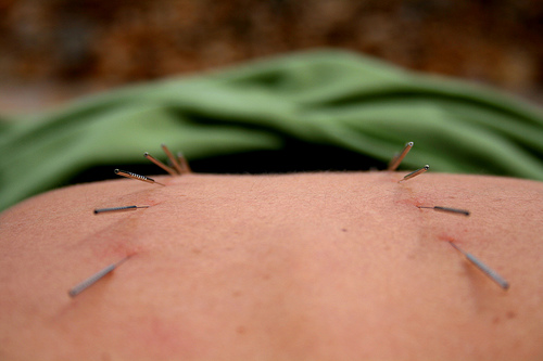 Needles to Ready the Body for a Baby