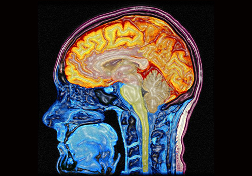 CT-scan av hjärnan. 