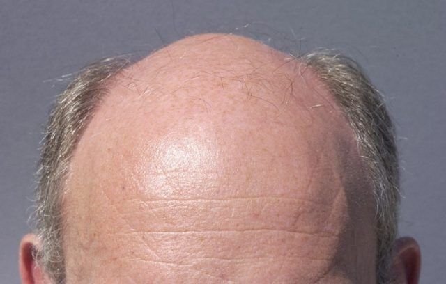In the future, will baldness recede from the lives of men? » Scienceline