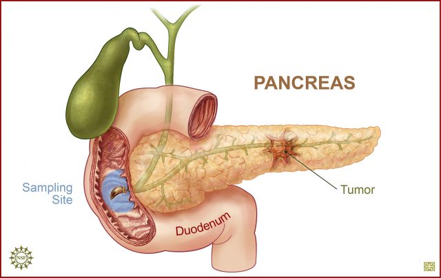 Should you get screened for pancreatic cancer?