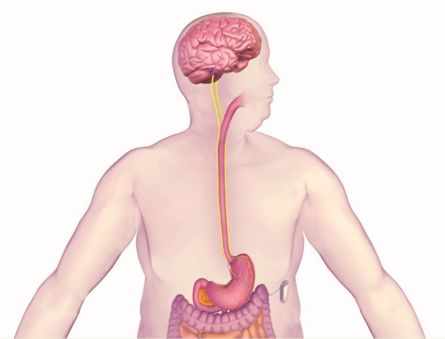 FDA approves implanted weight loss device