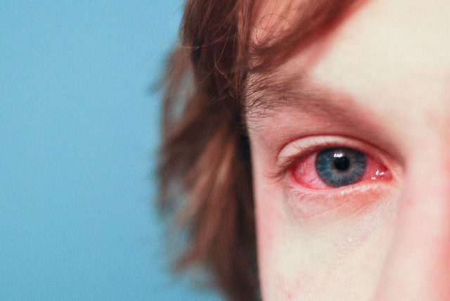 Why do allergies make our eyes swell?