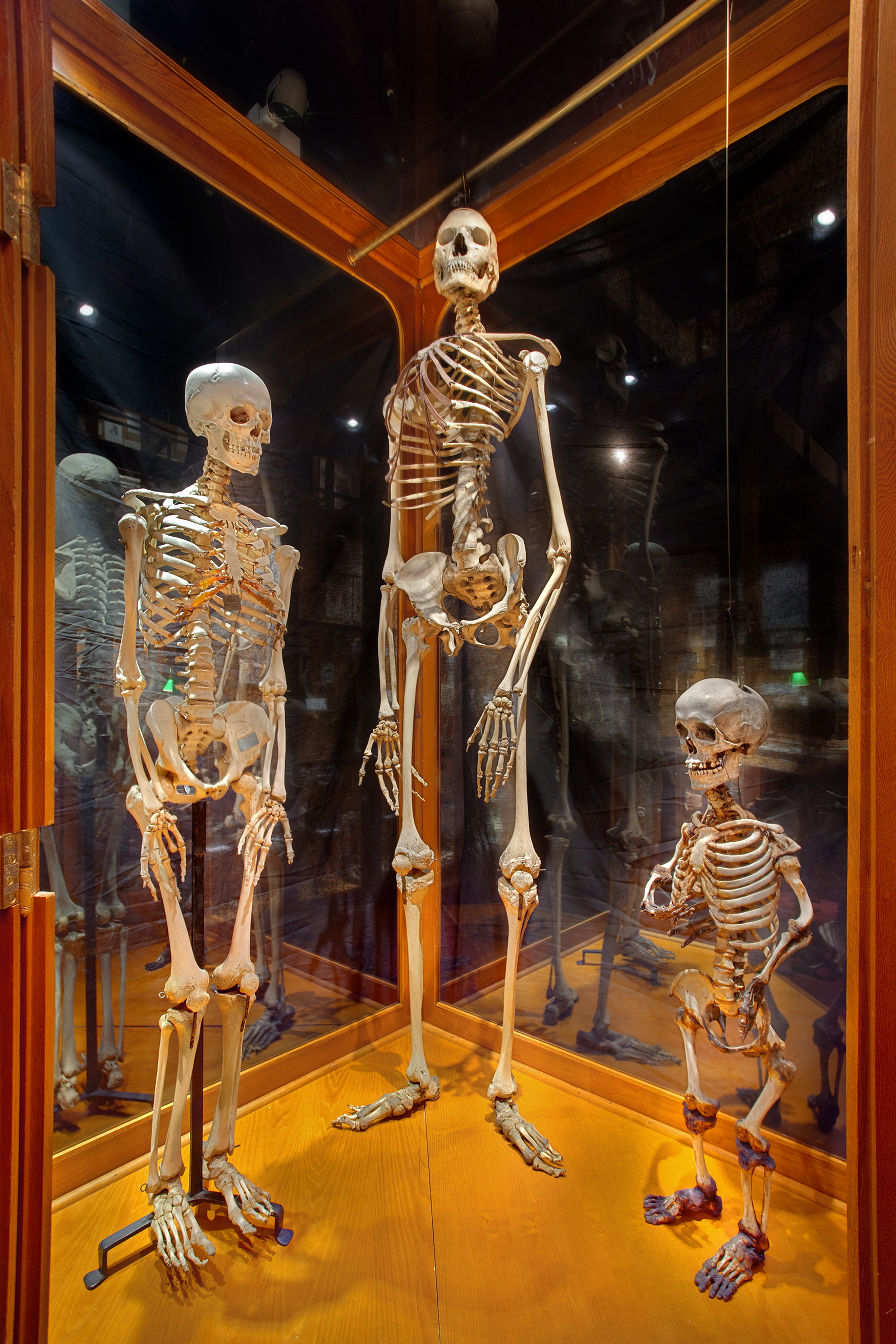 Mütter Museum of The College of Physicians of Philadelphia - The photograph  from earlier, shown again on the left, is the skeleton of a woman who wore  a corset that caused deformation