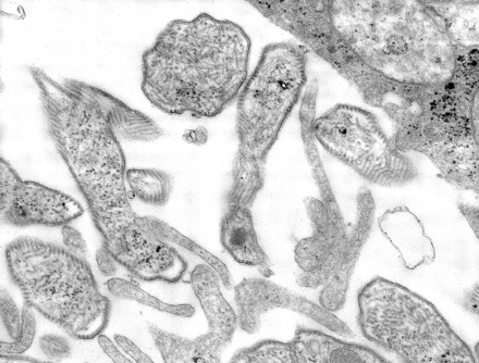 Mumps virions. CREDIT: A.HARRISON, F.A. MURPHY / CDC