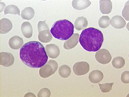 Leukemia cells highlighted with a Pappenheim stain. [CREDIT: CHRISTARAS A]