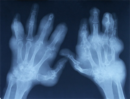 Arthritis-stricken hands. [CREDIT: SXC]