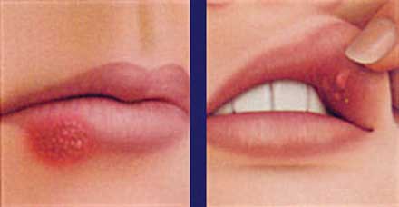 A cold sore, at left, and a canker sore, right. [CREDIT: COLGATE.COM]