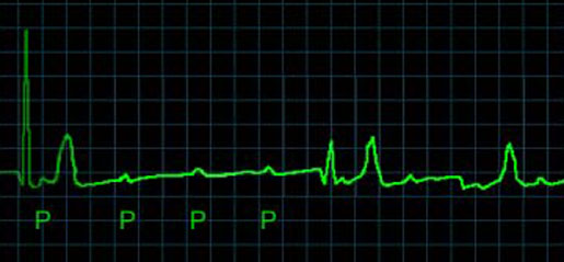 An electrocardiogram, or EKG, which measures the electrical activity of the heart. [CREDIT: NIH]