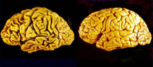 The brain of a person with Alzheimer's (left) compared to a normal brain (right). [CREDIT: The Commonwealth Scientific and Industrial Research Organisation of Australia]