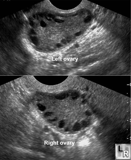 Ultrasound of ovaries showing many cysts. [Credit: Learningradiology.com]