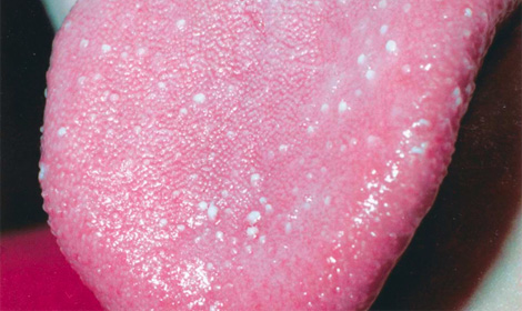 Tongue on white of bubble tip Canker sore