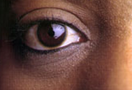 What causes bags under the eye? [CREDIT: NATIONAL EYE INSTITUTE, NIH]