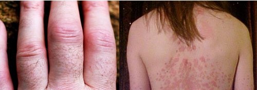 Rheumatoid arthritis (left) and psoriasis (right) are two of the disorders that may be caused by an excess of immune cells called Th-17. [Credit: David Jones, flickr.com (left); The Wednesday Island, Wikimedia (right)]