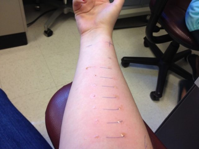 what-is-it-like-to-get-a-skin-allergy-test-scienceline