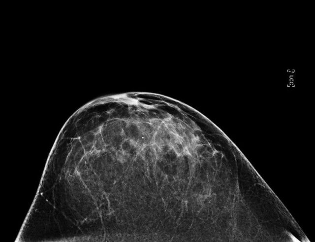 A mammogram image