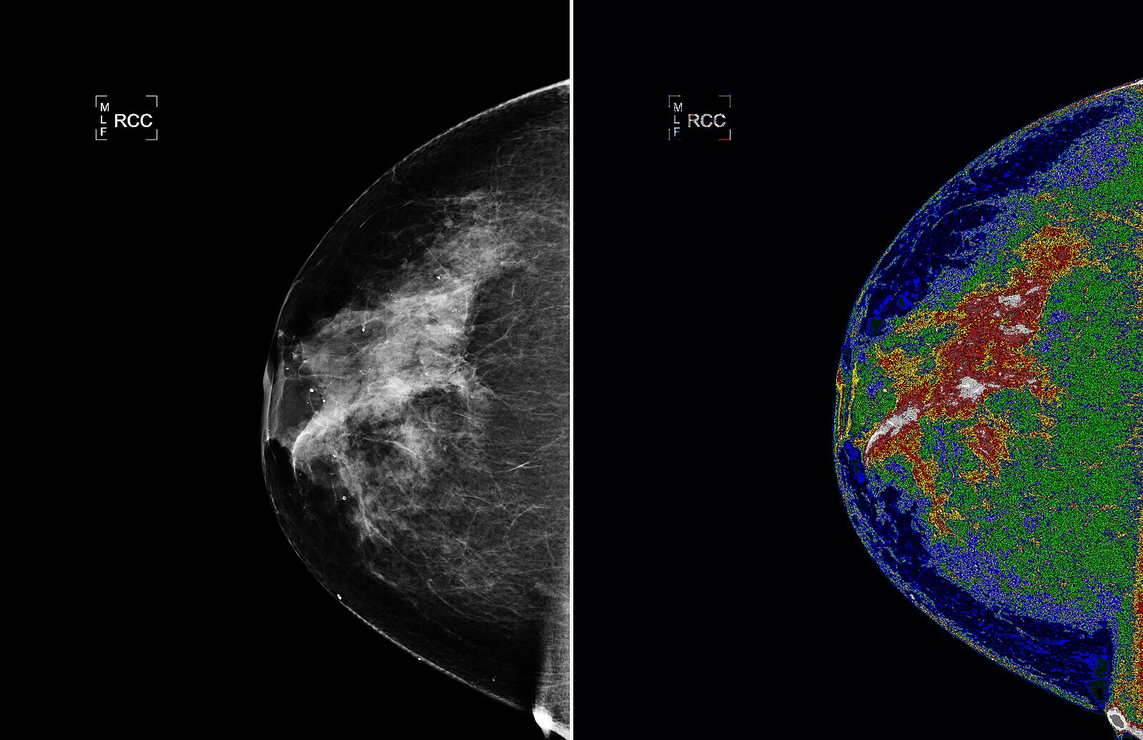 Two images from a mammogram different colors representing areas of varying breast density